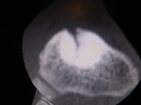 navicular stress fracture.