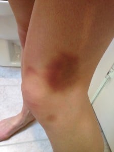 Neely's Knee From Her Blog (Click to be Taken to Blog Post)