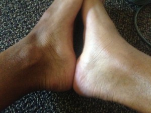 Jordan McNamara's swollen foot