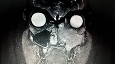 The initial tumor (on the right on this picture) overtook much of the left side of Nate's face